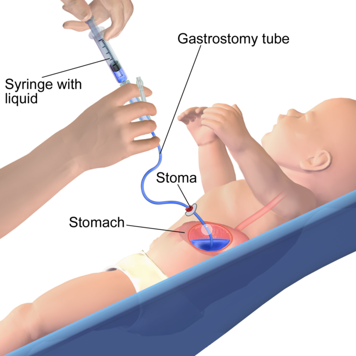 g-tubes-for-newborns