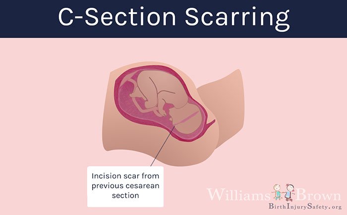 cesarean scar uterus
