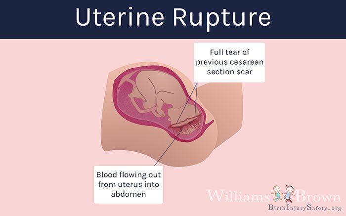 ruptured uterus