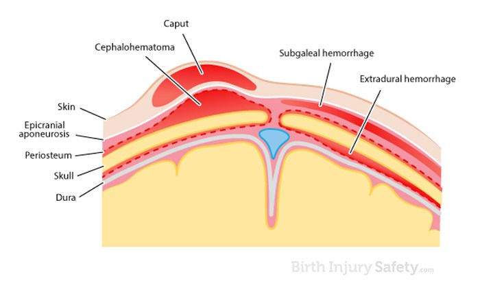Hemorrhage subaponeurotic Subaponeurotic haemorrhage