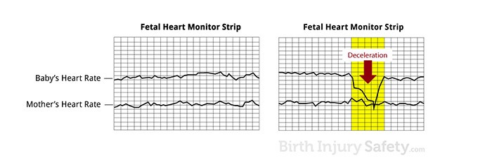 fetal heart rate during umbilical cord compression