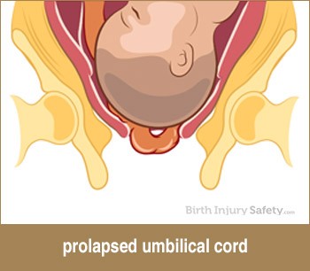 prolapsed umbilical cord