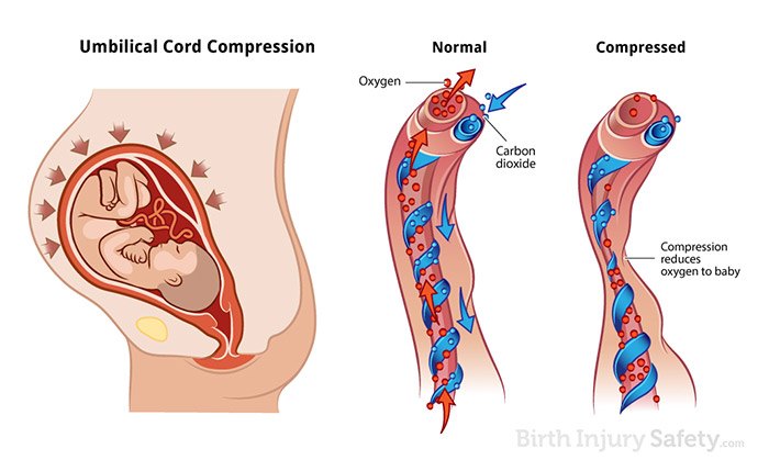 umbilical cord compression